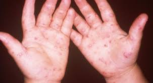 CPS advises community to take preventive measures to prevent Hand Foot and Mouth Disease & Chicken Pox