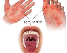 CPS advises community to take preventive measures to prevent Hand Foot and Mouth Disease