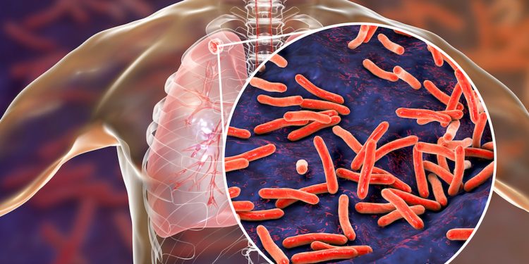 La tuberculosis es prevenible y curable. Evite contagiar la TB a otros