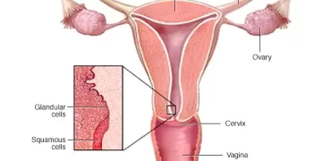 La segunda ronda de detección de cáncer de cuello uterino para mujeres de 50 a 60 años comenzará el lunes en St. Eustatius