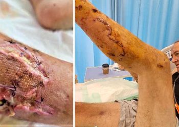 Constructor apenas sobrevive al ser atacado por tres Pit Bulls