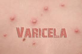 Los Servicios de Prevención Colectiva (CPS) hacen un llamado a la comunidad para que tome medidas preventivas para prevenir la varicela
