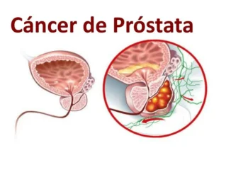 El CPS insta a los hombres a informarse sobre el cáncer de próstata y consultar a su médico sobre la detección temprana