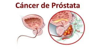 El CPS insta a los hombres a informarse sobre el cáncer de próstata y consultar a su médico sobre la detección temprana
