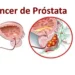 El CPS insta a los hombres a informarse sobre el cáncer de próstata y consultar a su médico sobre la detección temprana