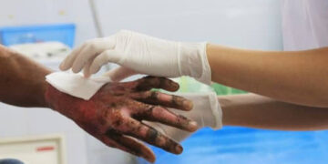 Grave incidente por quemaduras en un complejo turístico