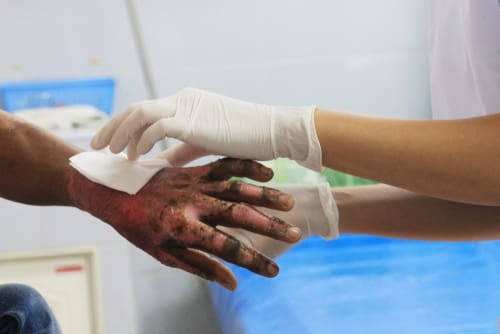 Worker Suffers Severe Burns at St. Maarten Resort